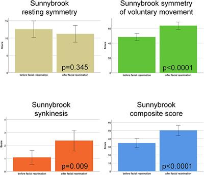 Functional Outcome and Quality of Life After Hypoglossal-Facial Jump Nerve Suture